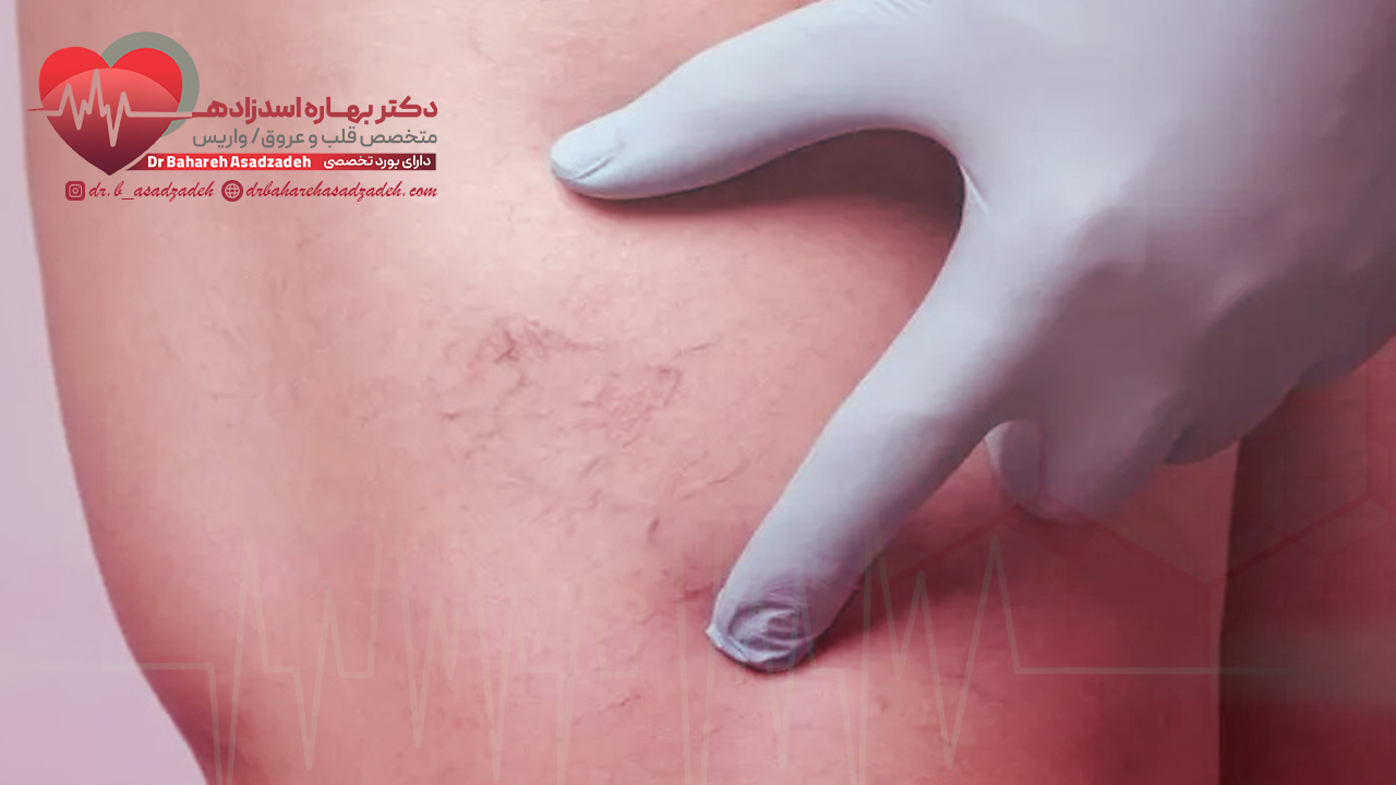 علت ایجاد واریس پا