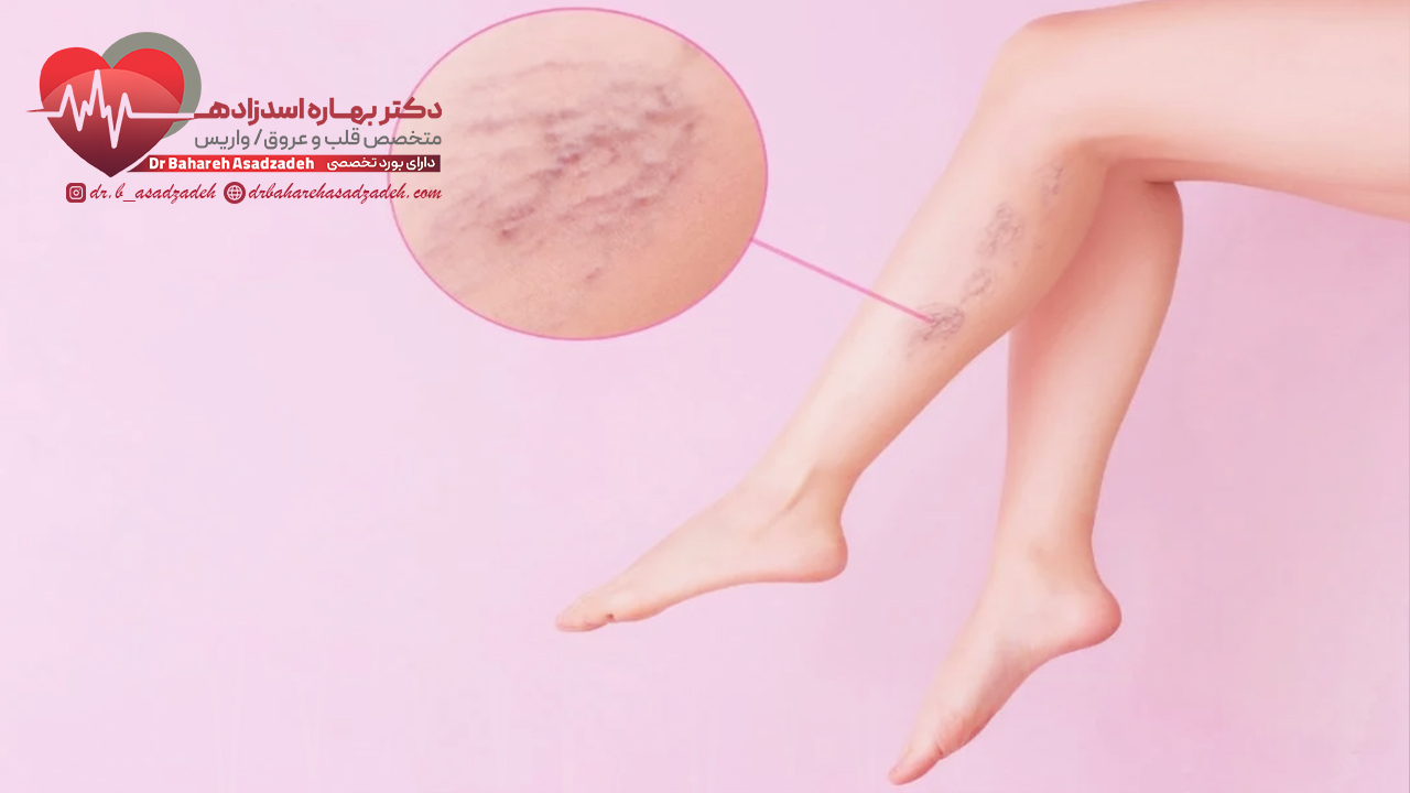 علل بروز واریس