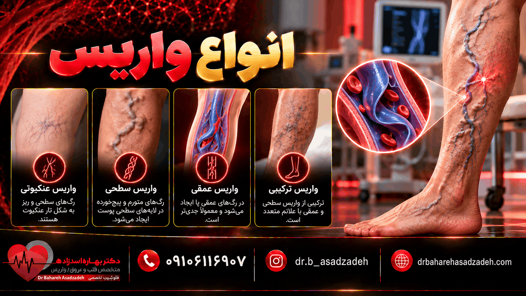 انواع واریس
