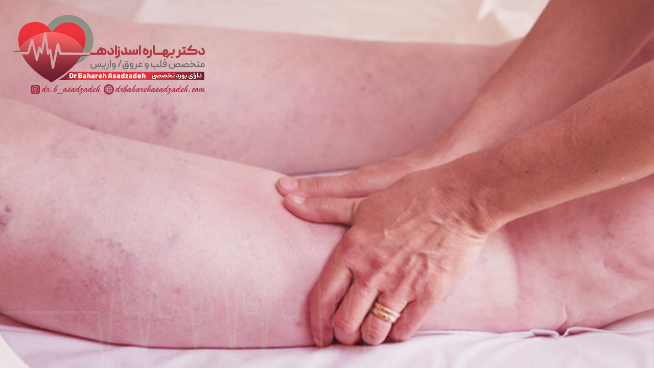 تشخیص ادم