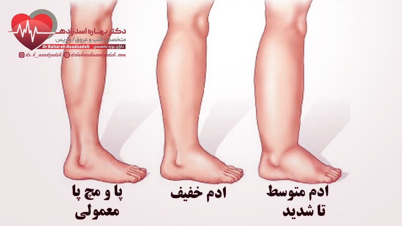 انواع اِدم