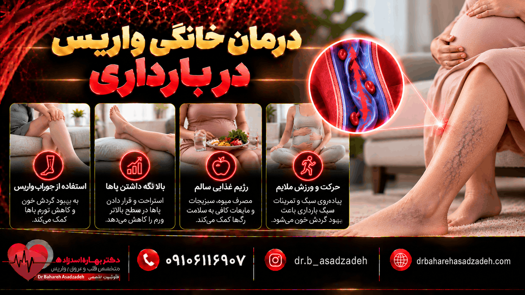 درمان خانگی واریس در بارداری