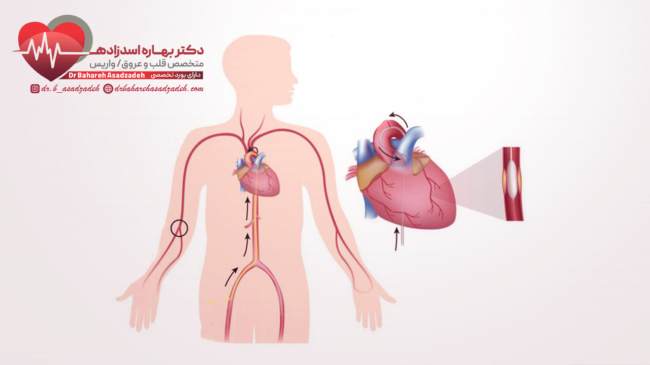 چگونگی انجام سی تی آنژیوگرافی
