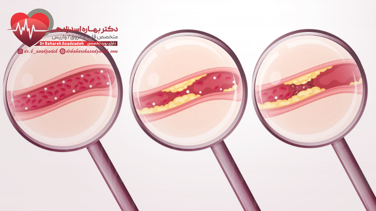 انواع گرفتگی رگ قلب