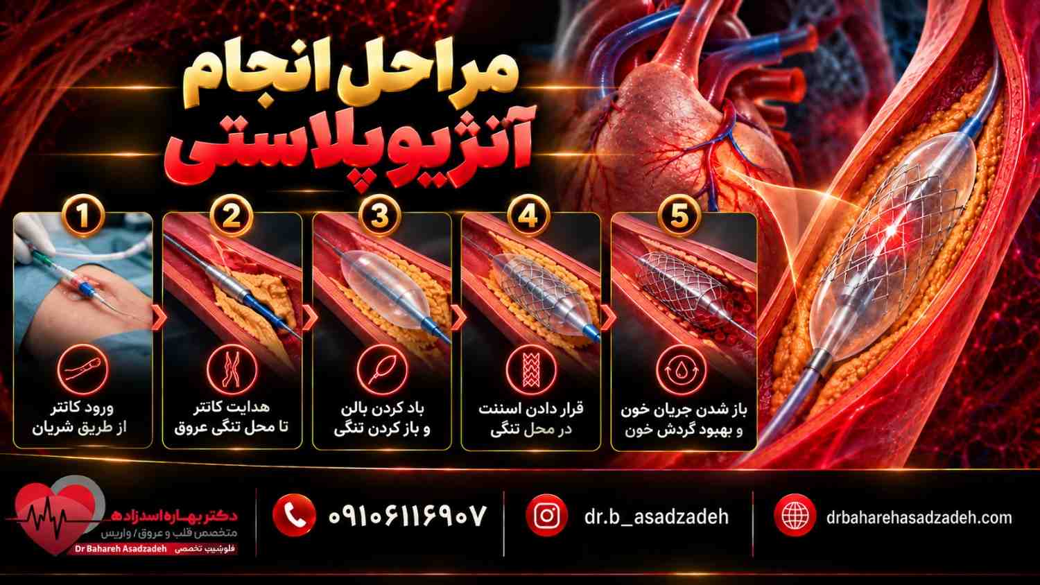 مراحل انجام آنژیوپلاستی