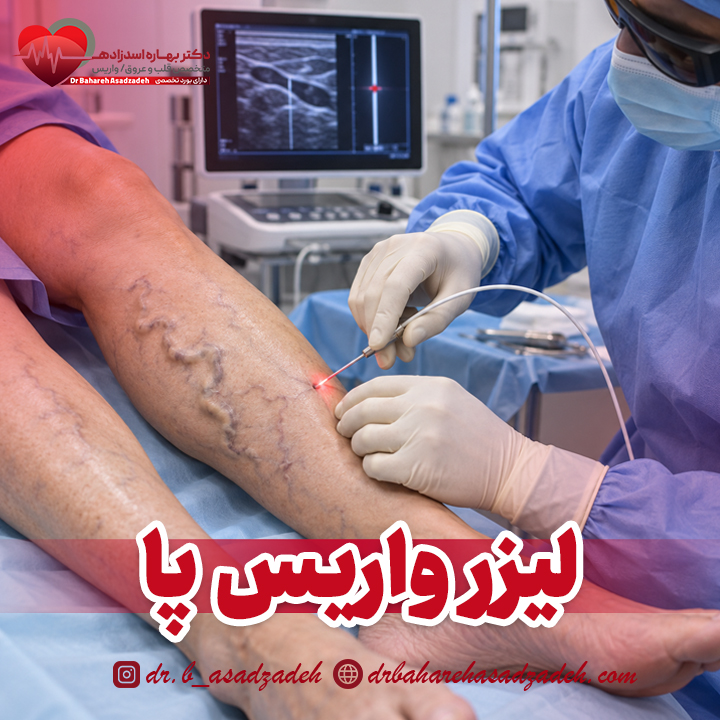 لیزر واریس پا